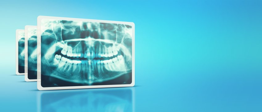 Promieniowanie rentgenowskie w stomatologii – bezpieczne dla pacjenta!