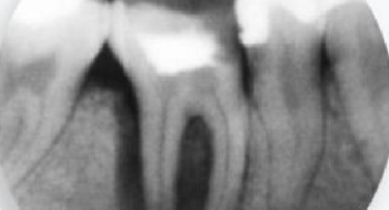 Periapical X-ray