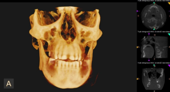 Tomografia CBCT