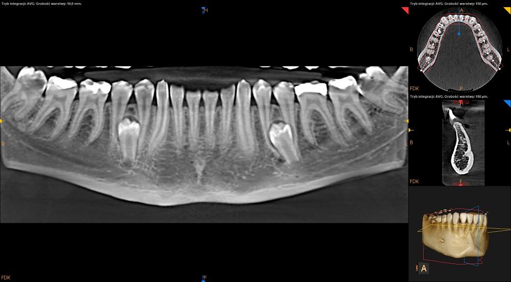 Tomografia CBCT żuchwy zęby nadliczbowe