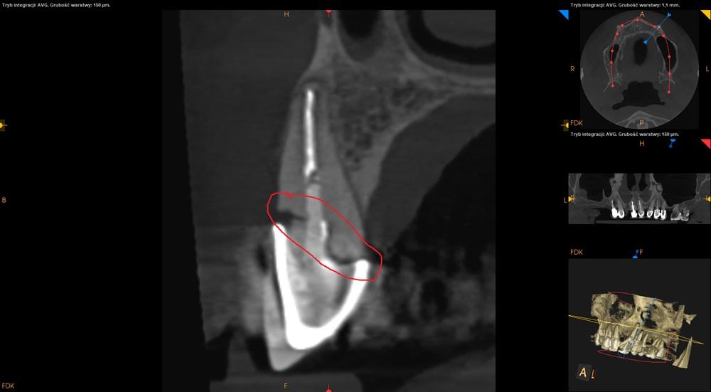 Złamanie korzenia zęba pod odbudową protetyczną